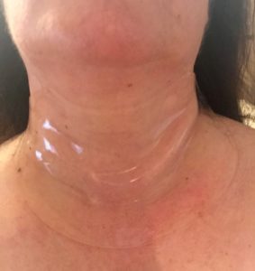 Neck Wrinkles Treatment