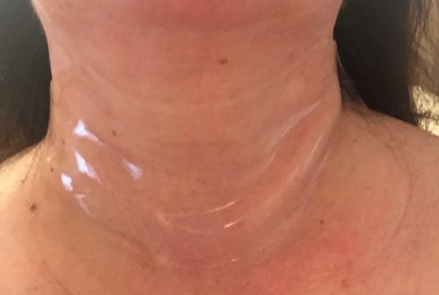 Neck Wrinkles Treatment