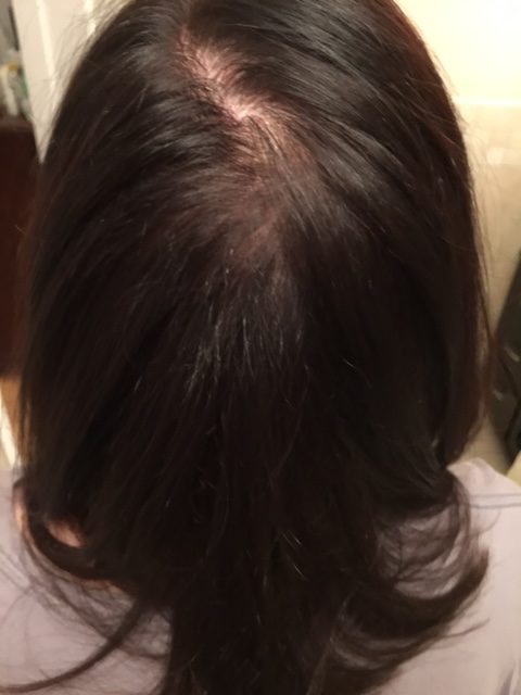 Before using iRestore Hair Growth System