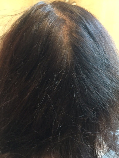 iRestore Hair Growth System