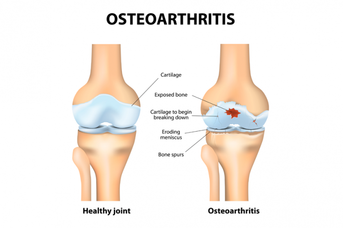 tips for arthritis pain